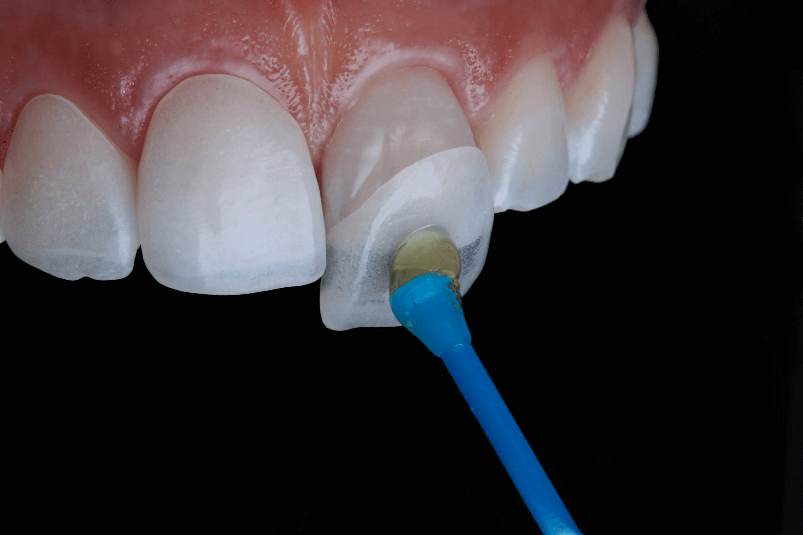 Dental Veneers New Westminster - Long-Lasting Dental Veneer Service